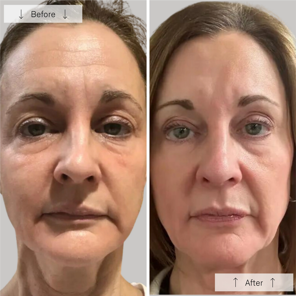 Omnilux Face Contour Bundle (2 Masks)